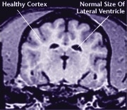 Healthy brain